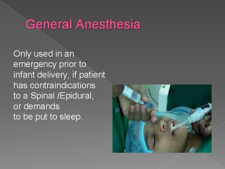 General Anesthesia Only used in an emergency prior to infant delivery, if patient has