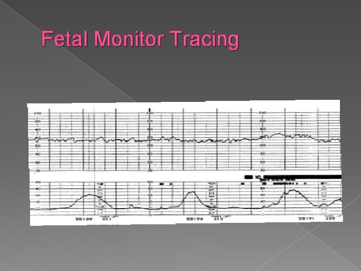 Fetal Monitor Tracing 