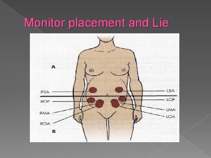 Monitor placement and Lie 