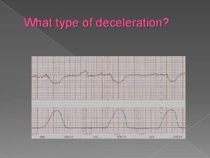 What type of deceleration? 