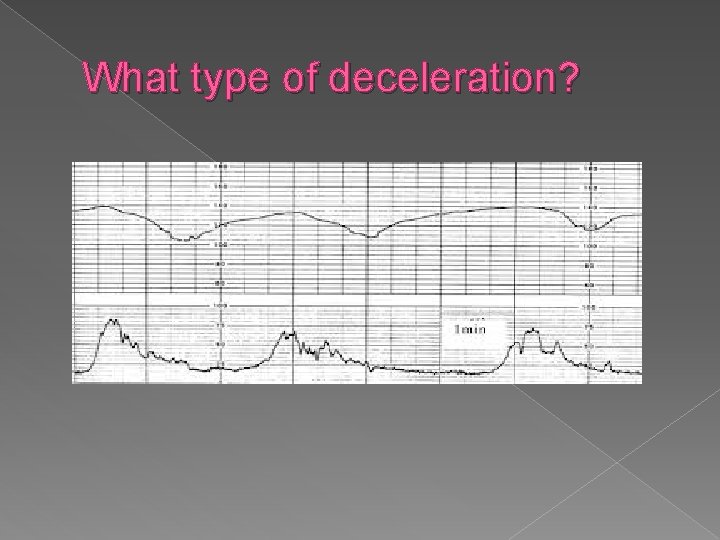 What type of deceleration? 
