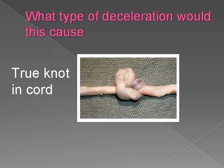 What type of deceleration would this cause True knot in cord 