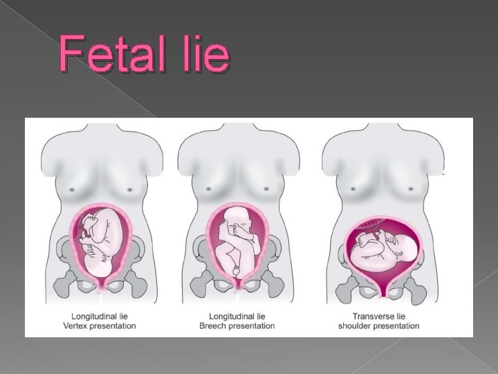 Fetal lie 