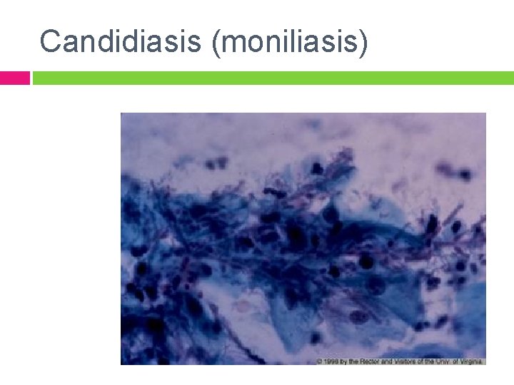 Candidiasis (moniliasis) 