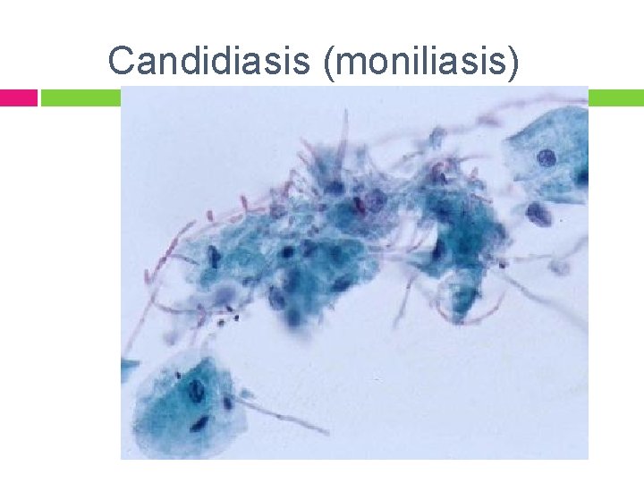 Candidiasis (moniliasis) 