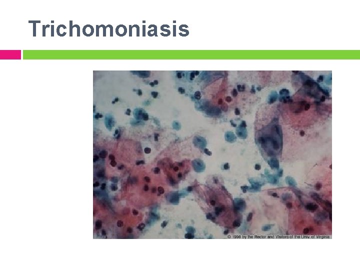 Trichomoniasis 