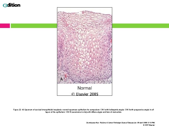 Figure 22 -19 Spectrum of cervical intraepithelial neoplasia: normal squamous epithelium for comparison; CIN