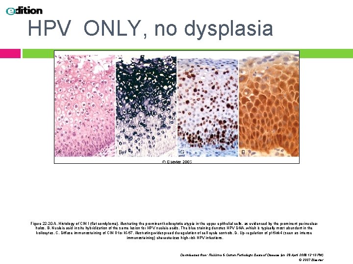 HPV ONLY, no dysplasia Figure 22 -20 A, Histology of CIN I (flat condyloma),