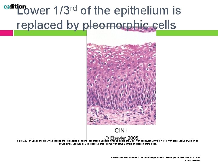 Lower 1/3 rd of the epithelium is replaced by pleomorphic cells Figure 22 -19