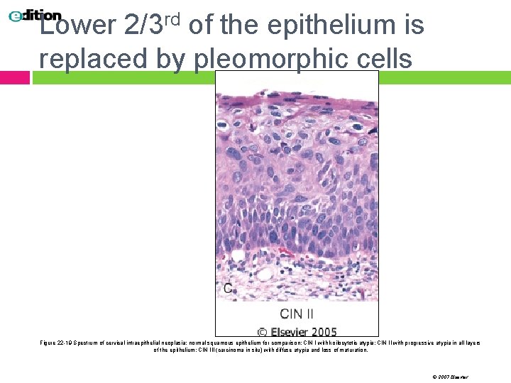 Lower 2/3 rd of the epithelium is replaced by pleomorphic cells Figure 22 -19