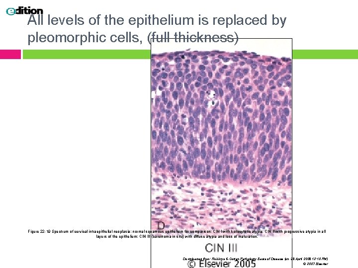 All levels of the epithelium is replaced by pleomorphic cells, (full thickness) Figure 22