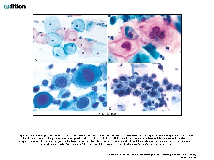 Figure 22 -21 The cytology of cervical intraepithelial neoplasia as seen on the Papanicolaou