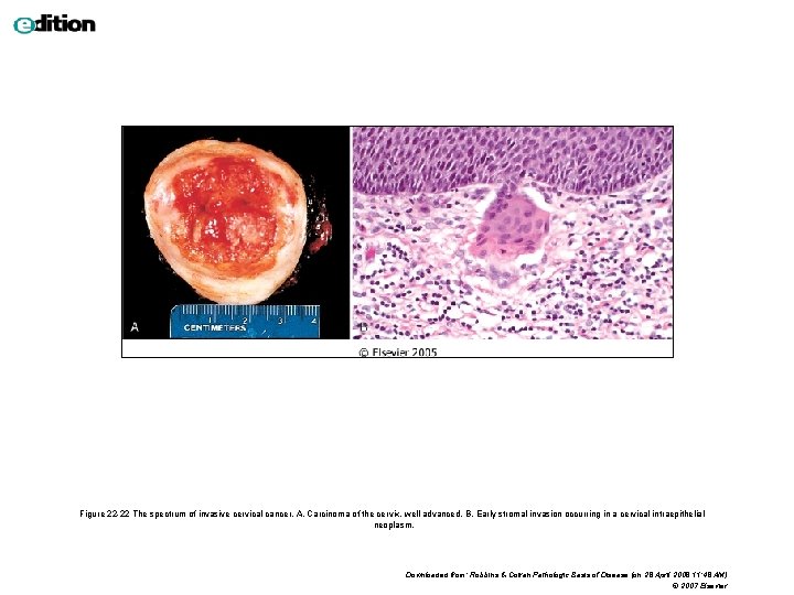 Figure 22 -22 The spectrum of invasive cervical cancer. A, Carcinoma of the cervix,