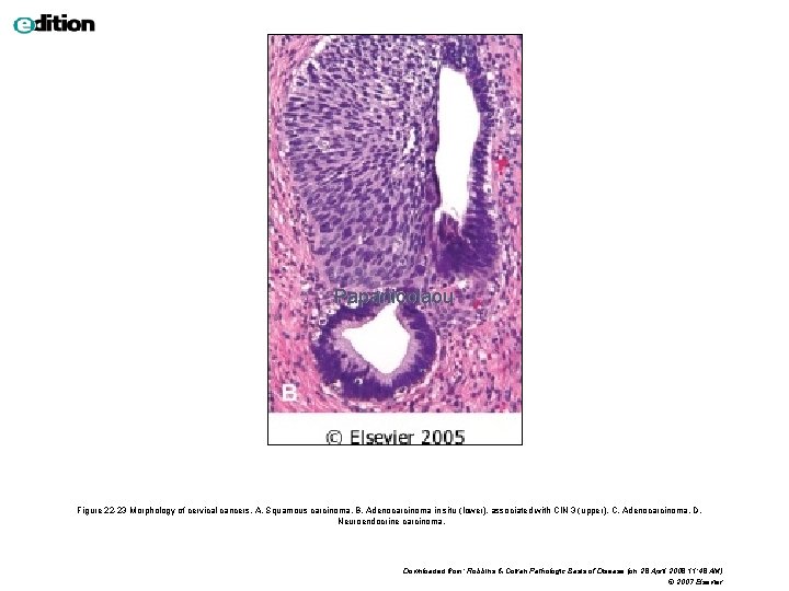Papanicolaou Figure 22 -23 Morphology of cervical cancers. A, Squamous carcinoma. B, Adenocarcinoma in
