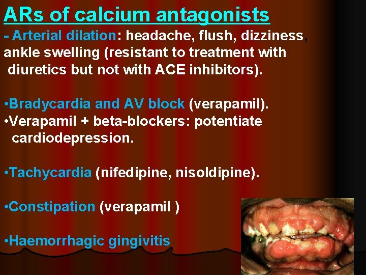 ARs of calcium antagonists - Arterial dilation: headache, flush, dizziness, ankle swelling (resistant to