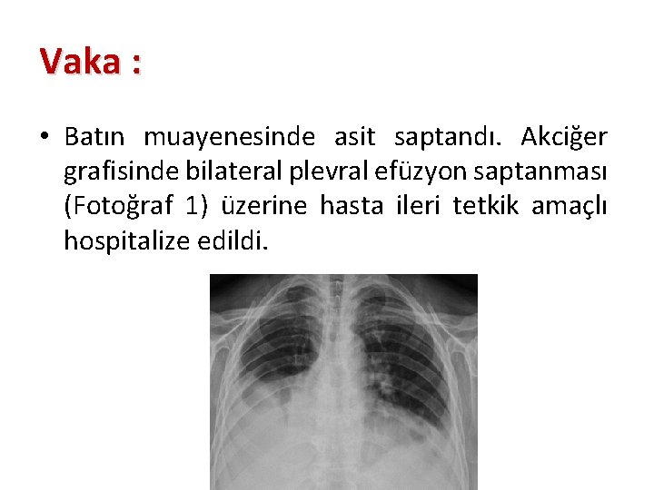 Vaka : : • Batın muayenesinde asit saptandı. Akciğer grafisinde bilateral plevral efüzyon saptanması