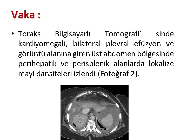 Vaka : • Toraks Bilgisayarlı Tomografi’ sinde kardiyomegali, bilateral plevral efüzyon ve görüntü alanına