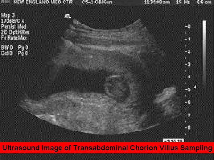 Ultrasound Image of Transabdominal Chorion Villus Sampling 