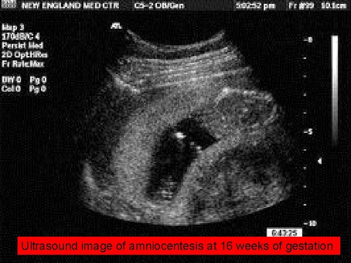 Ultrasound image of amniocentesis at 16 weeks of gestation 