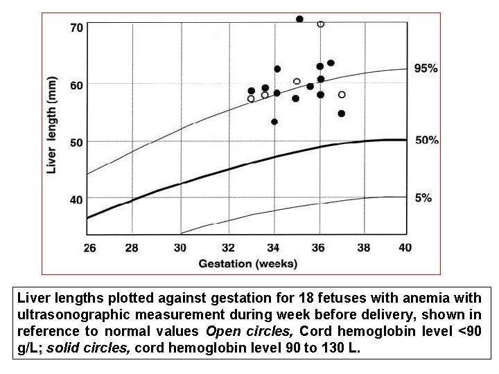 Liver lengths plotted against gestation for 18 fetuses with anemia with ultrasonographic measurement during