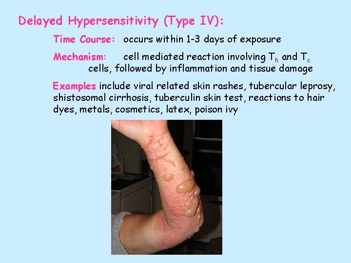 Delayed Hypersensitivity (Type IV): Time Course: occurs within 1 -3 days of exposure Mechanism: