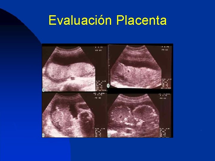 Evaluación Placenta 