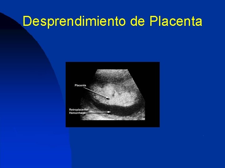 Desprendimiento de Placenta 