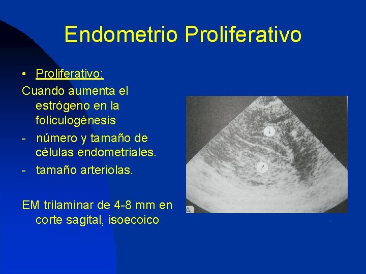 Endometrio Proliferativo • Proliferativo: Cuando aumenta el estrógeno en la foliculogénesis - número y