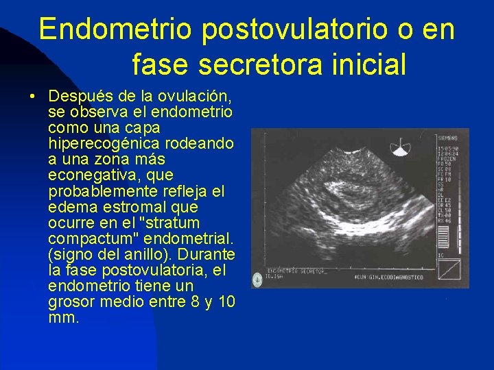 Endometrio postovulatorio o en fase secretora inicial • Después de la ovulación, se observa