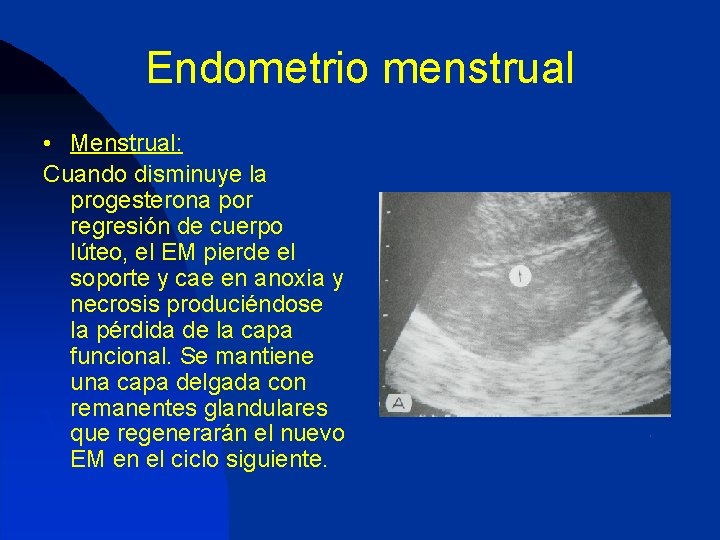 Endometrio menstrual • Menstrual: Cuando disminuye la progesterona por regresión de cuerpo lúteo, el