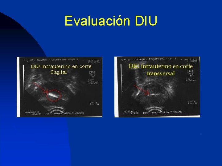 Evaluación DIU 