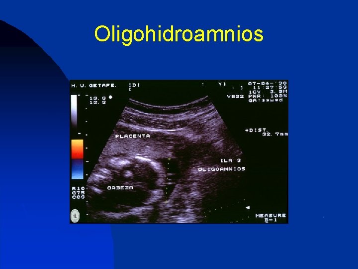 Oligohidroamnios 