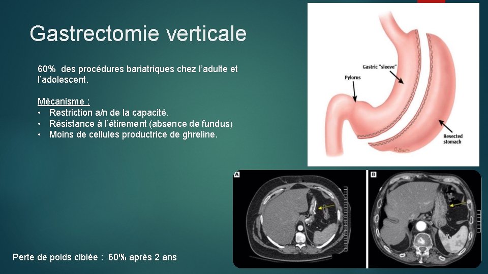 Gastrectomie verticale 60% des procédures bariatriques chez l’adulte et l’adolescent. Mécanisme : • Restriction