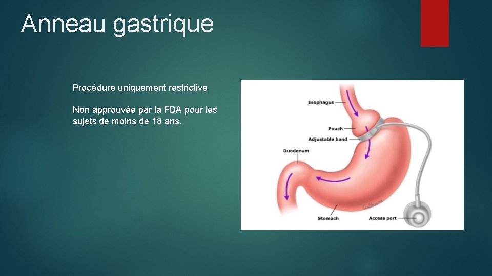 Anneau gastrique Procédure uniquement restrictive Non approuvée par la FDA pour les sujets de