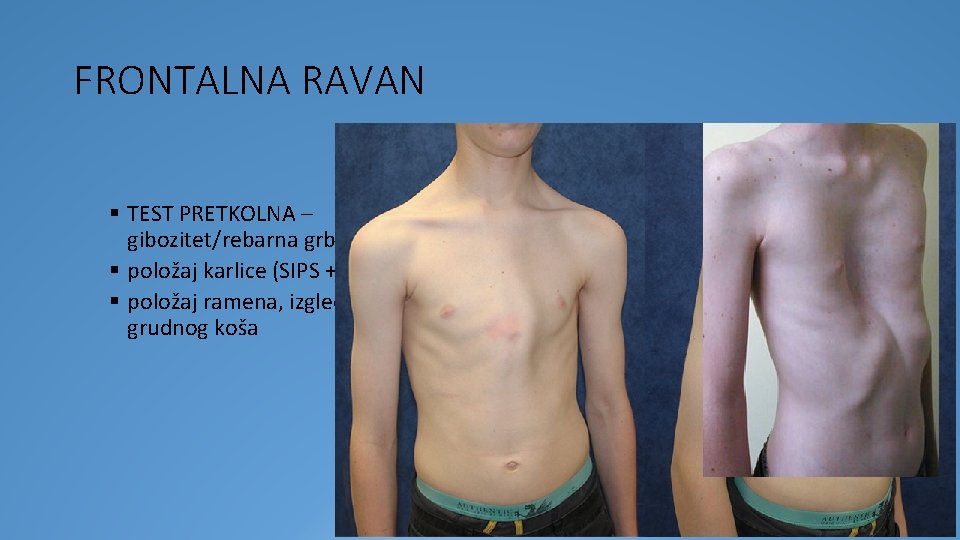FRONTALNA RAVAN § TEST PRETKOLNA – gibozitet/rebarna grba § položaj karlice (SIPS + SIAS)