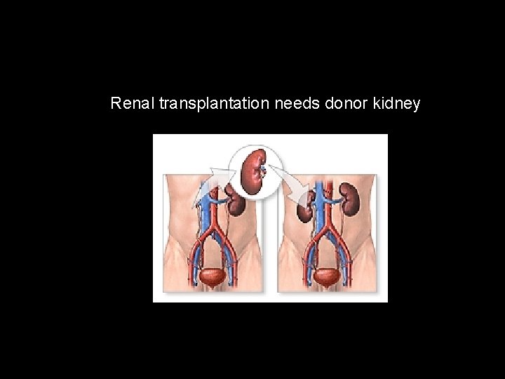 Renal transplantation needs donor kidney 