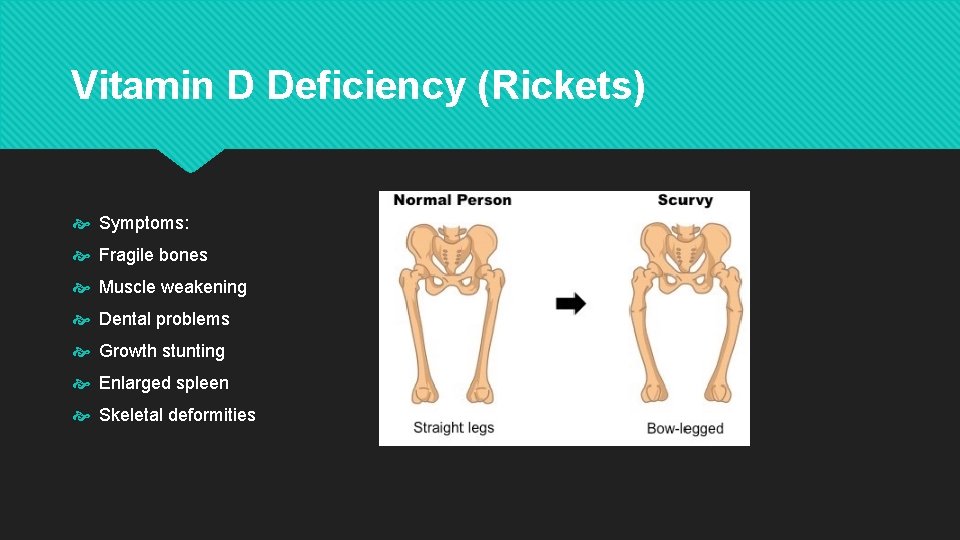 Vitamin D Deficiency (Rickets) Symptoms: Fragile bones Muscle weakening Dental problems Growth stunting Enlarged