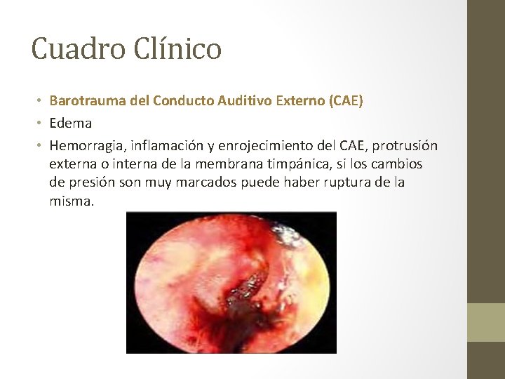 Cuadro Clínico • Barotrauma del Conducto Auditivo Externo (CAE) • Edema • Hemorragia, inflamación