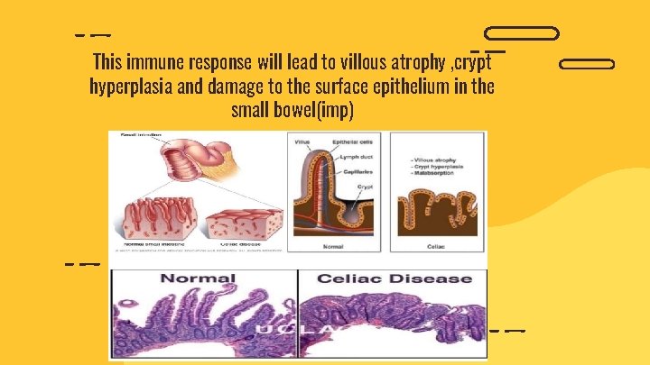 This immune response will lead to villous atrophy , crypt hyperplasia and damage to