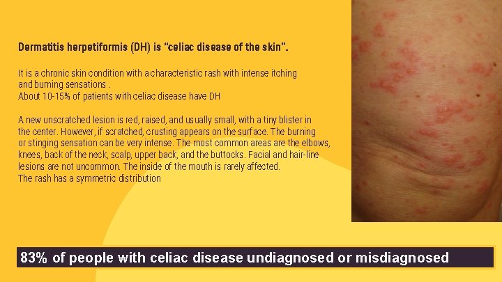 Dermatitis herpetiformis (DH) is “celiac disease of the skin”. It is a chronic skin