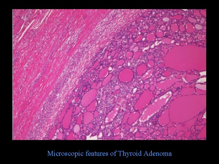 Microscopic features of Thyroid Adenoma 