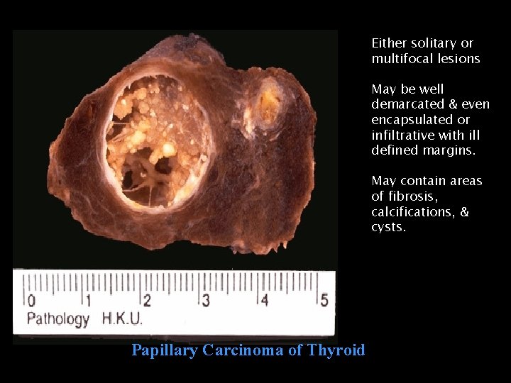 Either solitary or multifocal lesions May be well demarcated & even encapsulated or infiltrative