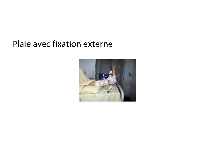 Plaie avec fixation externe 