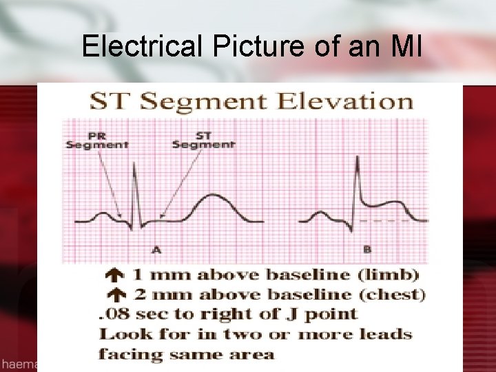 Electrical Picture of an MI 