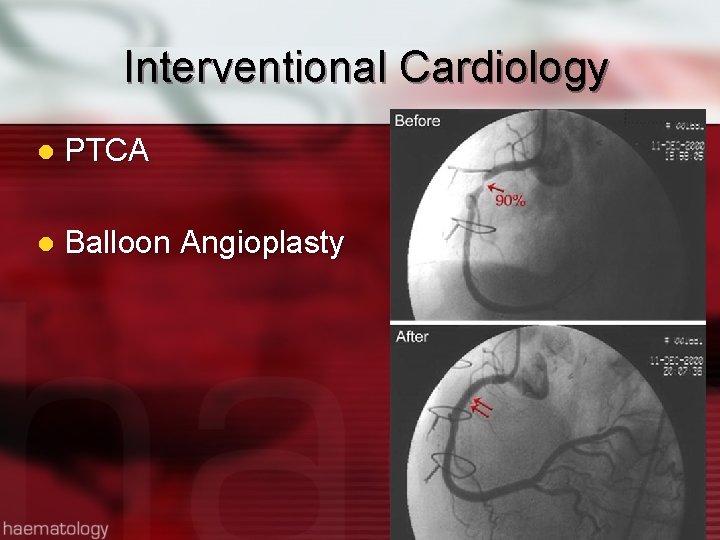 Interventional Cardiology l PTCA l Balloon Angioplasty 