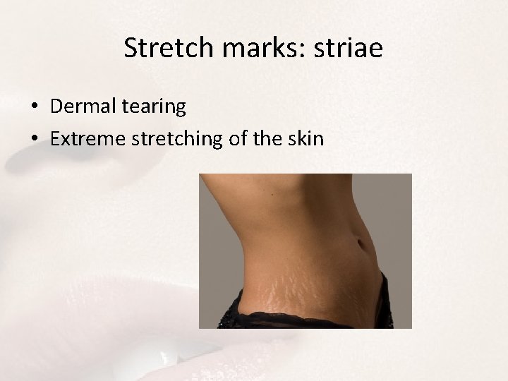 Stretch marks: striae • Dermal tearing • Extreme stretching of the skin 