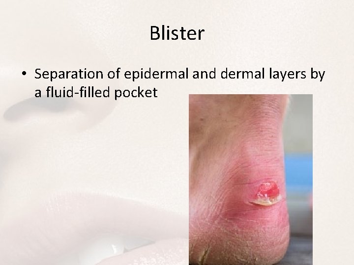 Blister • Separation of epidermal and dermal layers by a fluid-filled pocket 