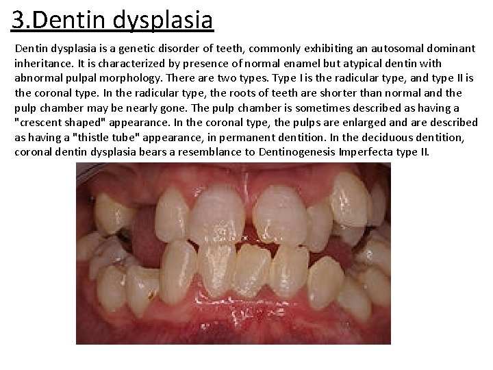 3. Dentin dysplasia is a genetic disorder of teeth, commonly exhibiting an autosomal dominant