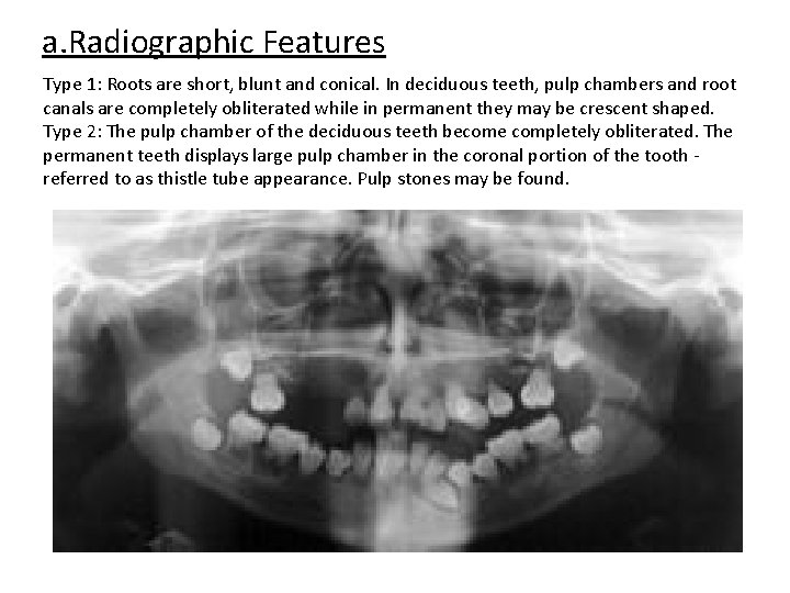 a. Radiographic Features Type 1: Roots are short, blunt and conical. In deciduous teeth,