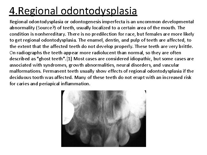 4. Regional odontodysplasia or odontogenesis imperfecta is an uncommon developmental abnormality (Source? ) of